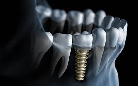 استفاده از تجربیات لامبورگینی در زمینه فیبر کربن جهت ساخت ایمپلنت‌های دندان